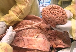 B3: Brain Tissue, Nuclei, Fluid & Peripheral Nervous System